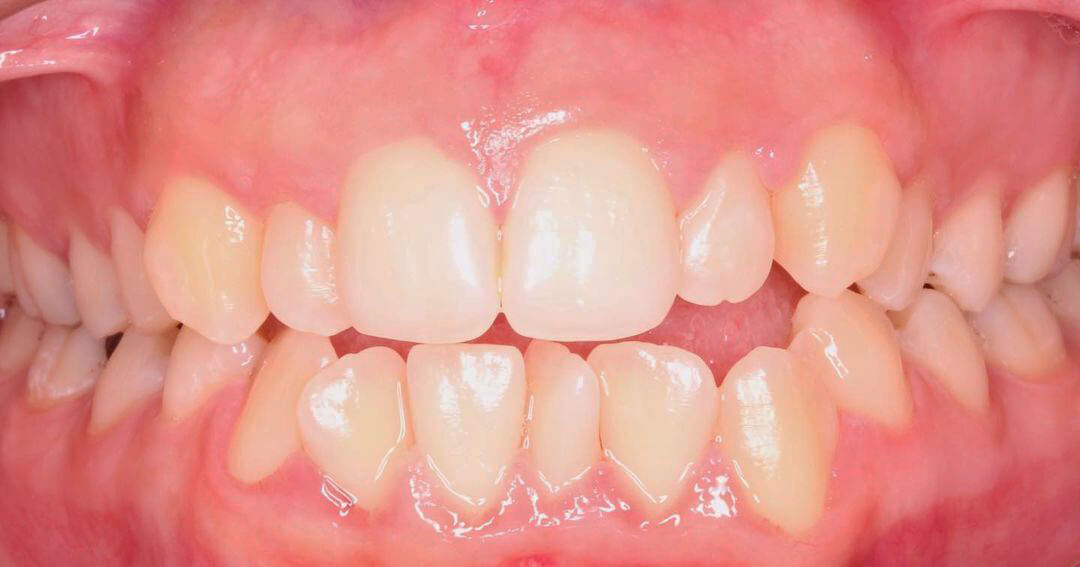 Denti prima del trattamento Invisalign