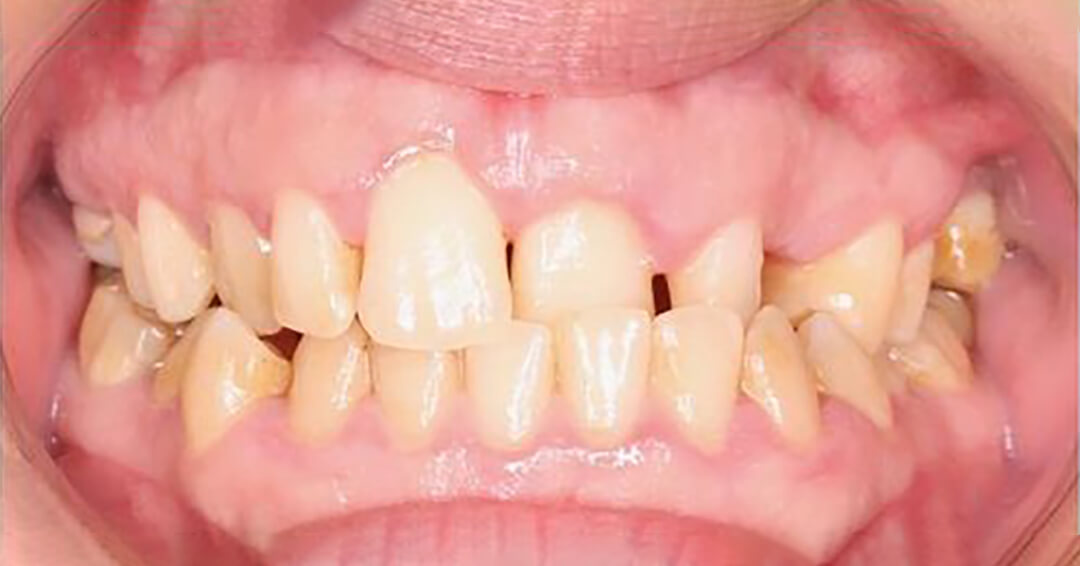 Denti prima del trattamento Invisalign