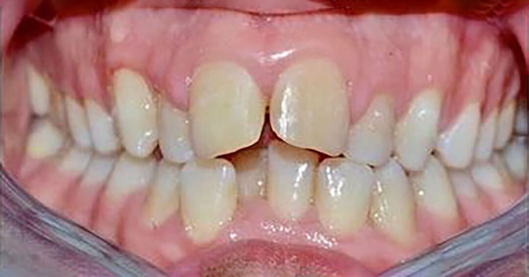 Denti prima del trattamento Invisalign