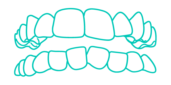 Trattamento Invisalign per denti affollati