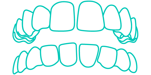 Trattamento Invisalign per denti con spazi