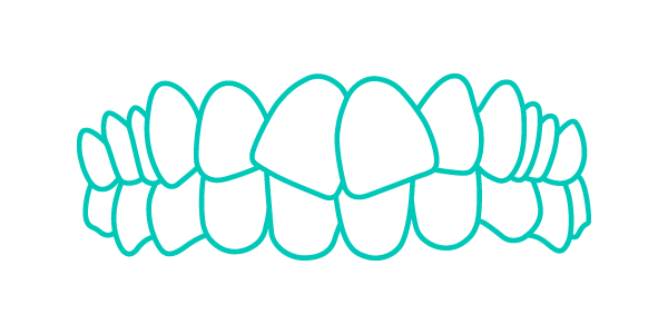 Trattamento Invisalign per denti generalmente dritti