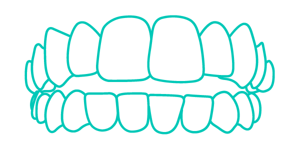 Trattamento Invisalign per denti con morso aperto