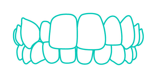 Trattamento Invisalign per denti con morso crociato