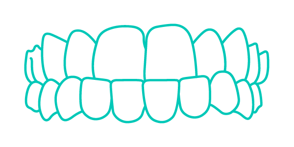 Trattamento Invisalign per denti con morso profondo