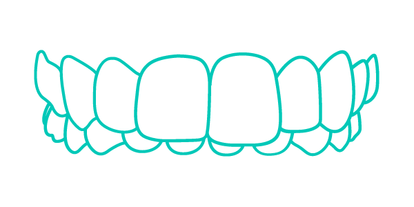 Trattamento Invisalign per denti con morso profondo